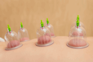 Cupping